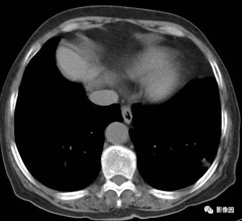 【病例】左下肺鳞癌1例CT 【病例】左下肺鳞癌1例CT