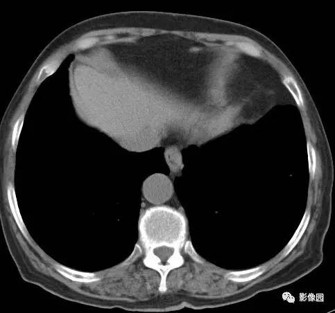 【病例】左下肺鳞癌1例CT 【病例】左下肺鳞癌1例CT