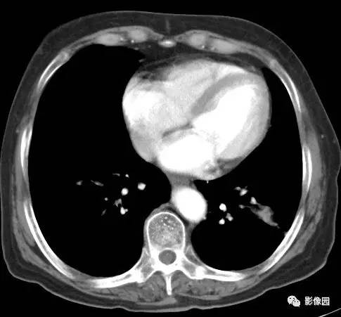 【病例】左下肺鳞癌1例CT 【病例】左下肺鳞癌1例CT