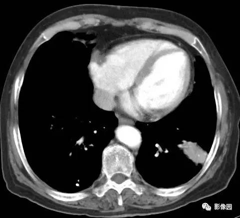【病例】左下肺鳞癌1例CT 【病例】左下肺鳞癌1例CT