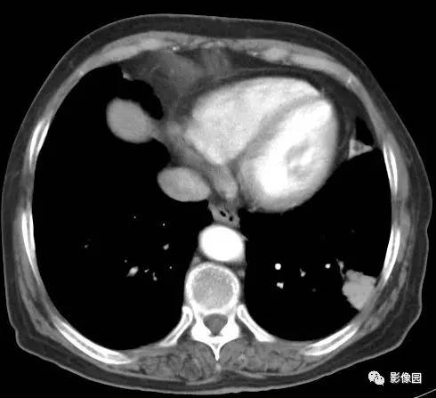 【病例】左下肺鳞癌1例CT 【病例】左下肺鳞癌1例CT