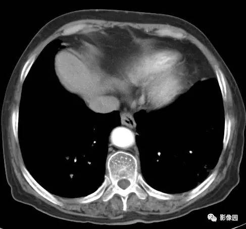 【病例】左下肺鳞癌1例CT 【病例】左下肺鳞癌1例CT