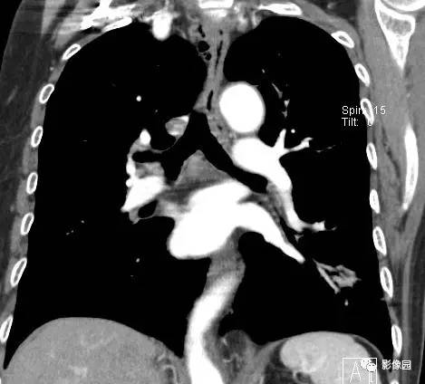 【病例】左下肺鳞癌1例CT 【病例】左下肺鳞癌1例CT