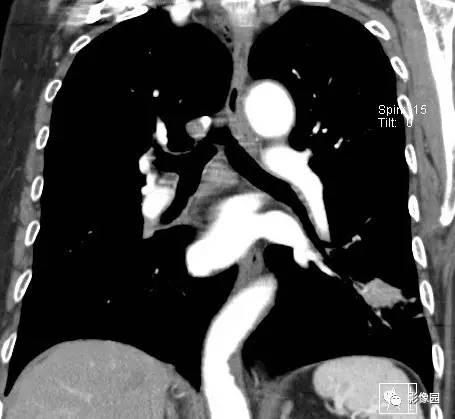 【病例】左下肺鳞癌1例CT 【病例】左下肺鳞癌1例CT
