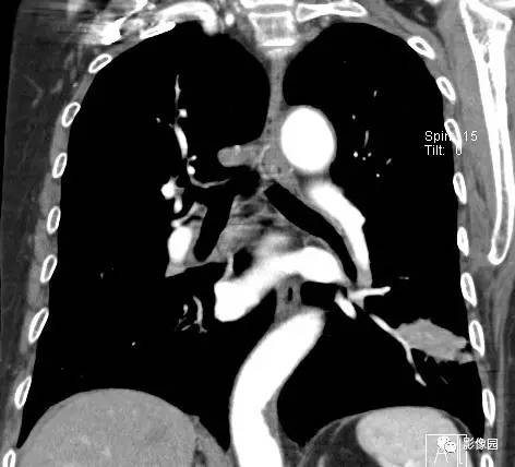 【病例】左下肺鳞癌1例CT 【病例】左下肺鳞癌1例CT