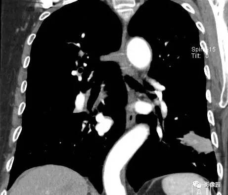 【病例】左下肺鳞癌1例CT 【病例】左下肺鳞癌1例CT