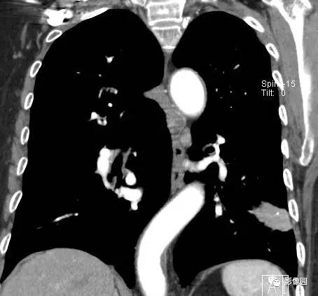 【病例】左下肺鳞癌1例CT 【病例】左下肺鳞癌1例CT