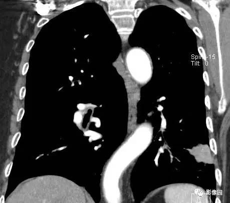 【病例】左下肺鳞癌1例CT 【病例】左下肺鳞癌1例CT