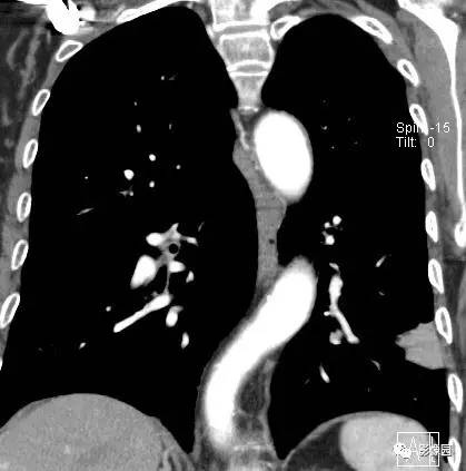 【病例】左下肺鳞癌1例CT 【病例】左下肺鳞癌1例CT