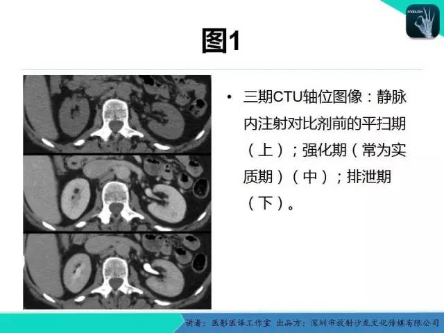 【PPT】​CT尿路造影对输尿管疾病的评价