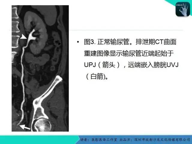 【PPT】​CT尿路造影对输尿管疾病的评价