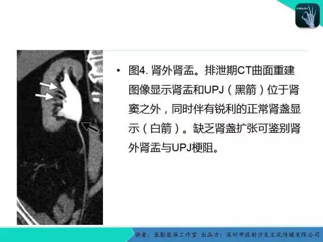 【PPT】​CT尿路造影对输尿管疾病的评价