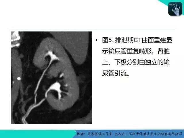 【PPT】​CT尿路造影对输尿管疾病的评价