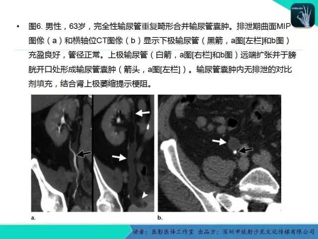 【PPT】​CT尿路造影对输尿管疾病的评价