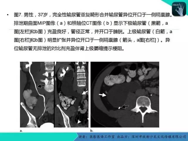 【PPT】​CT尿路造影对输尿管疾病的评价
