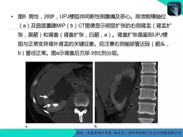 【PPT】​CT尿路造影对输尿管疾病的评价