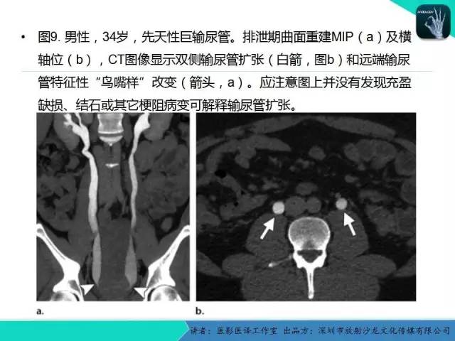 【PPT】​CT尿路造影对输尿管疾病的评价