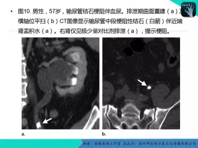 【PPT】​CT尿路造影对输尿管疾病的评价