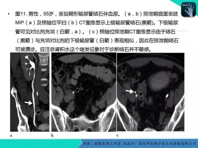 【PPT】​CT尿路造影对输尿管疾病的评价