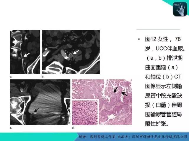 【PPT】​CT尿路造影对输尿管疾病的评价