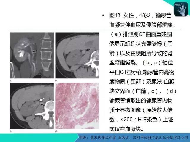 【PPT】​CT尿路造影对输尿管疾病的评价
