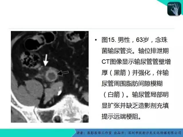 【PPT】​CT尿路造影对输尿管疾病的评价