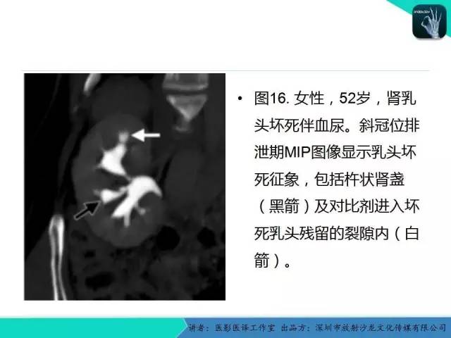 【PPT】​CT尿路造影对输尿管疾病的评价