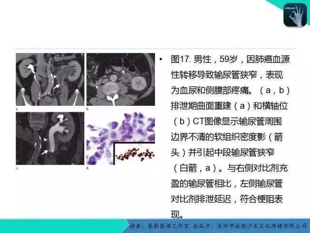 【PPT】​CT尿路造影对输尿管疾病的评价