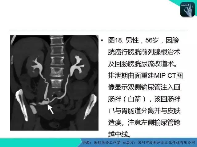 【PPT】​CT尿路造影对输尿管疾病的评价