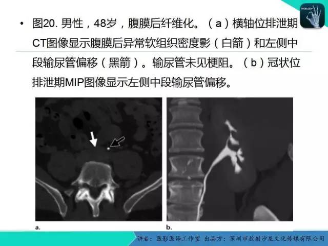 【PPT】​CT尿路造影对输尿管疾病的评价