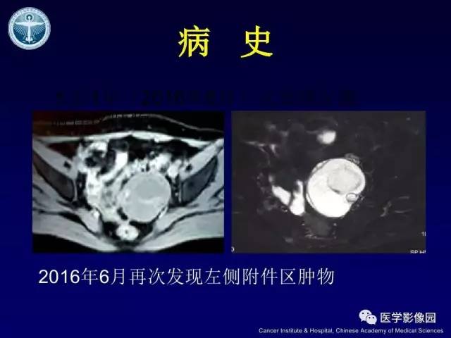 【病例】宫颈腺癌伴卵巢转移1例MR