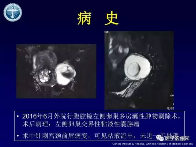 【病例】宫颈腺癌伴卵巢转移1例MR