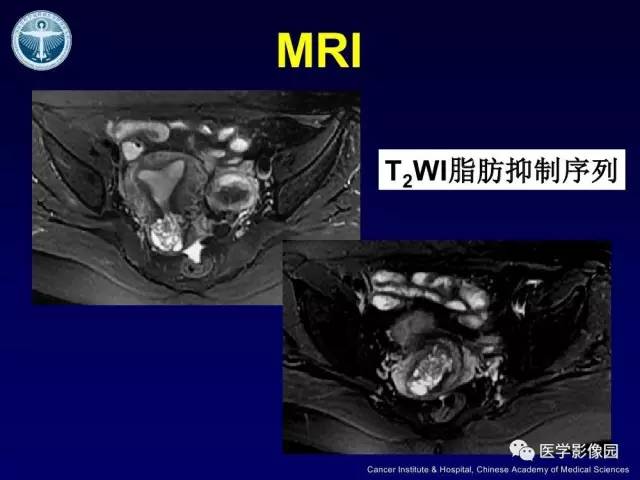 【病例】宫颈腺癌伴卵巢转移1例MR