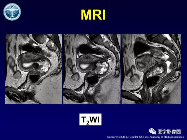 【病例】宫颈腺癌伴卵巢转移1例MR