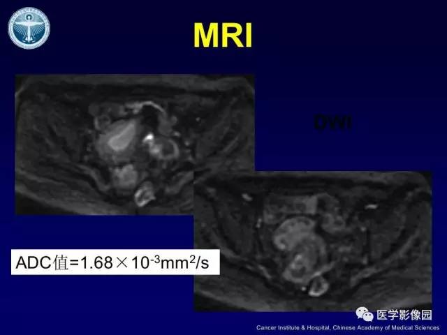 【病例】宫颈腺癌伴卵巢转移1例MR