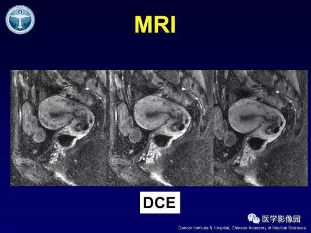 【病例】宫颈腺癌伴卵巢转移1例MR