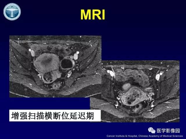 【病例】宫颈腺癌伴卵巢转移1例MR