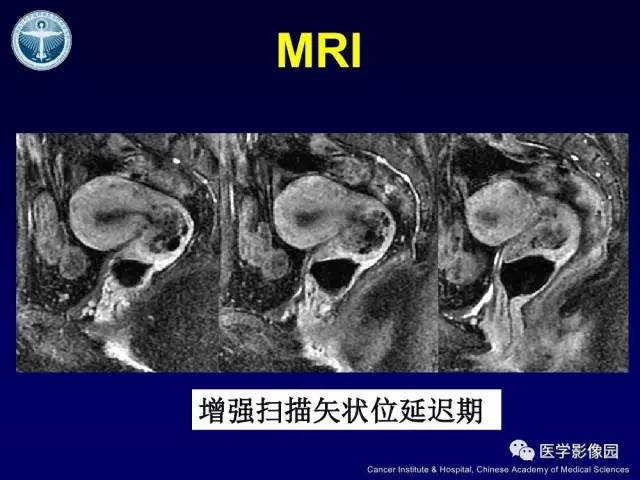 【病例】宫颈腺癌伴卵巢转移1例MR