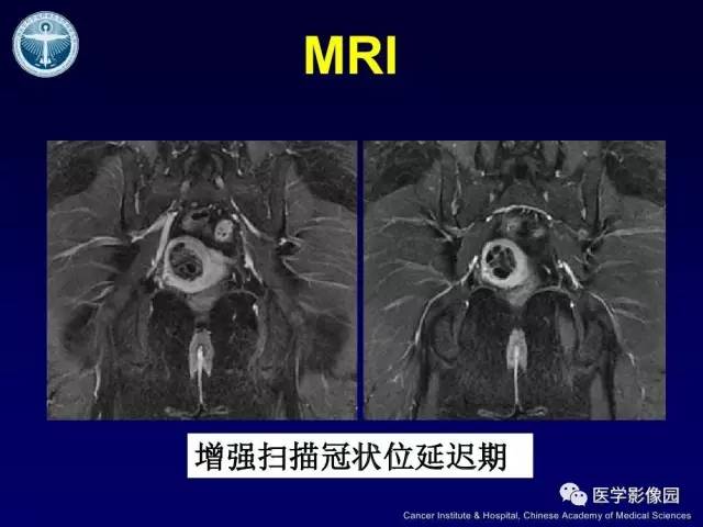 【病例】宫颈腺癌伴卵巢转移1例MR