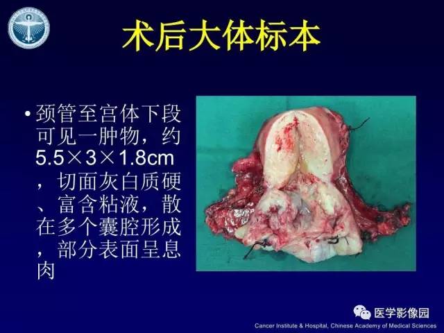 【病例】宫颈腺癌伴卵巢转移1例MR