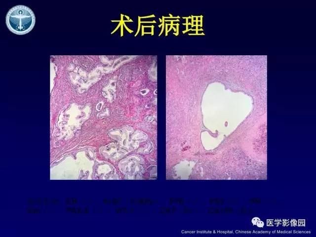【病例】宫颈腺癌伴卵巢转移1例MR