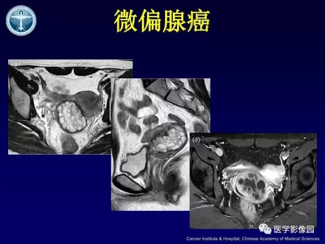 【病例】宫颈腺癌伴卵巢转移1例MR