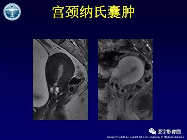 【病例】宫颈腺癌伴卵巢转移1例MR