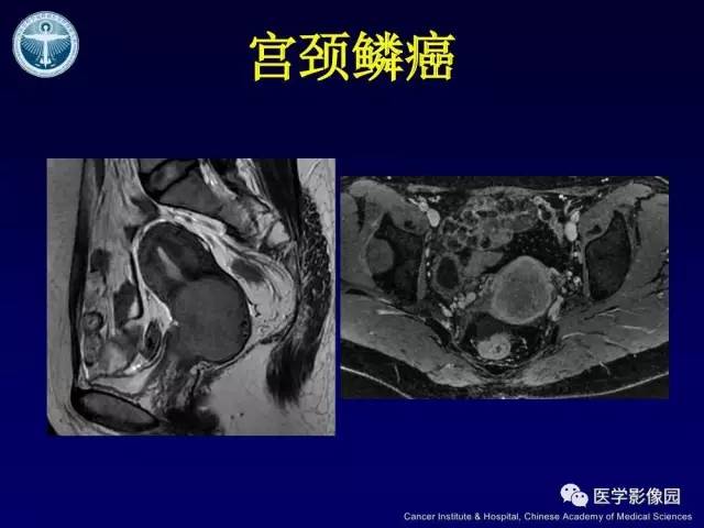 【病例】宫颈腺癌伴卵巢转移1例MR