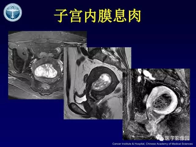 【病例】宫颈腺癌伴卵巢转移1例MR