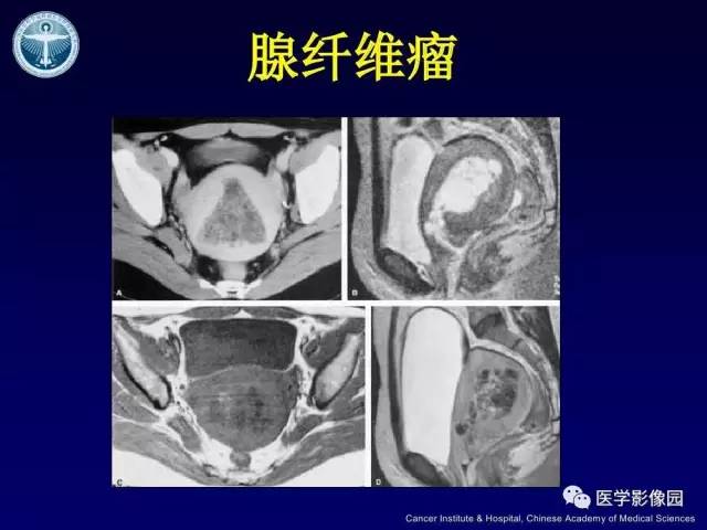 【病例】宫颈腺癌伴卵巢转移1例MR