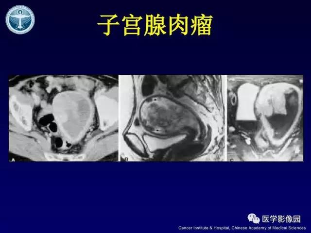 【病例】宫颈腺癌伴卵巢转移1例MR