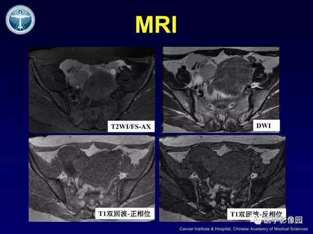 【病例】卵巢甲状腺肿1例CT及MR