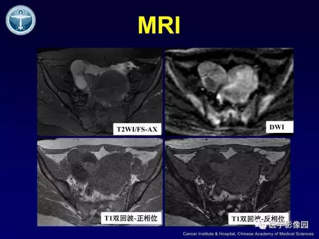 【病例】卵巢甲状腺肿1例CT及MR