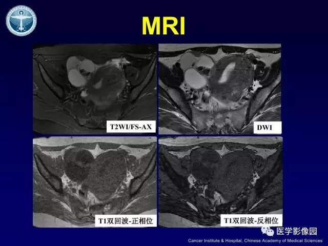 【病例】卵巢甲状腺肿1例CT及MR